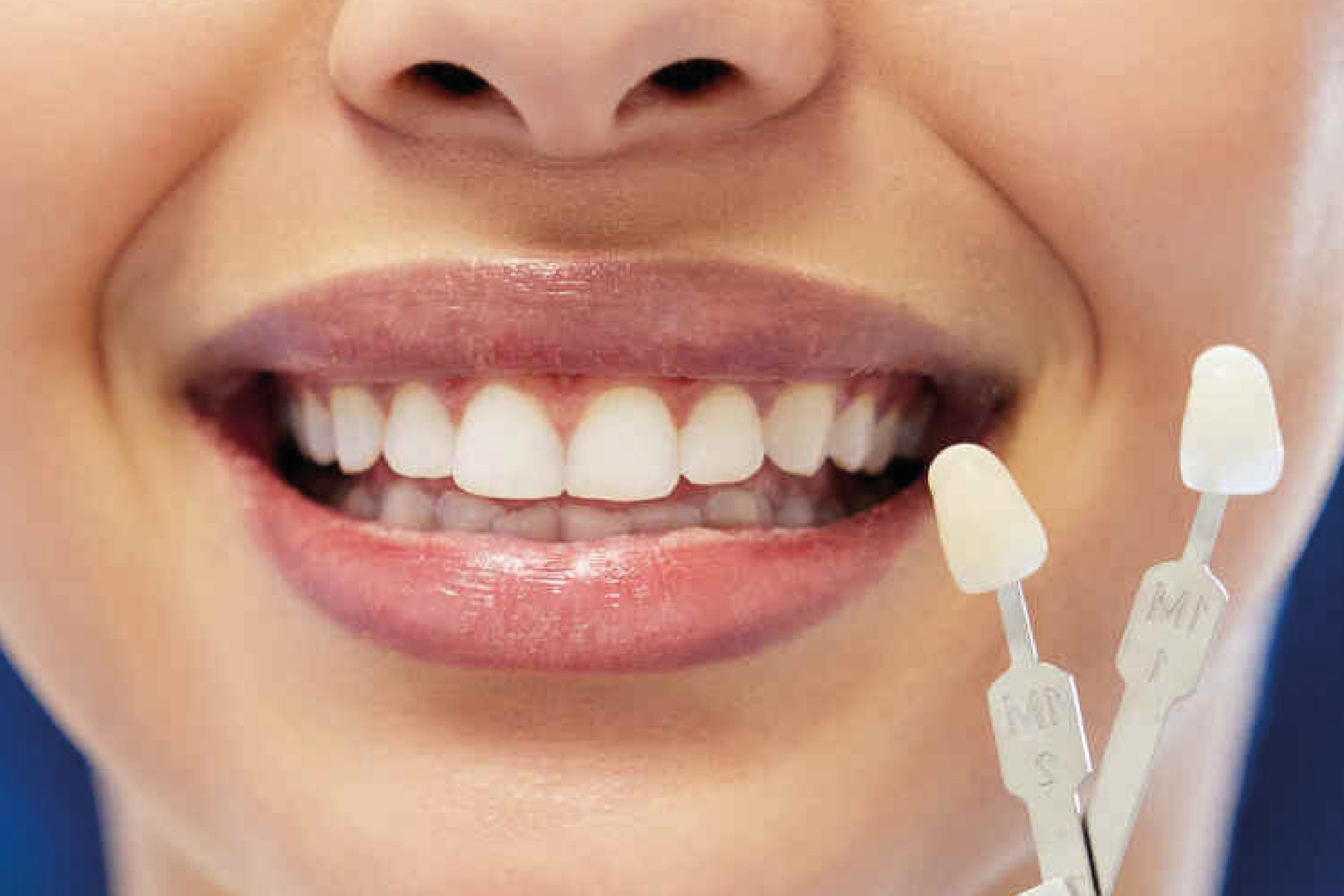 Faccette Dentali